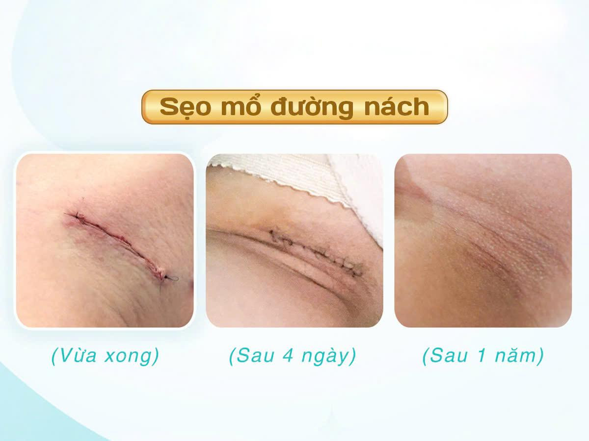 Phẫu thuật nâng ngực nội soi qua đường nách là bước tiến vượt bậc, mang lại sự hài lòng về cả vẻ đẹp và độ an toàn.