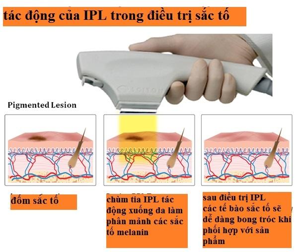 Công nghệ IPL và cơ chế hoạt động trên da.