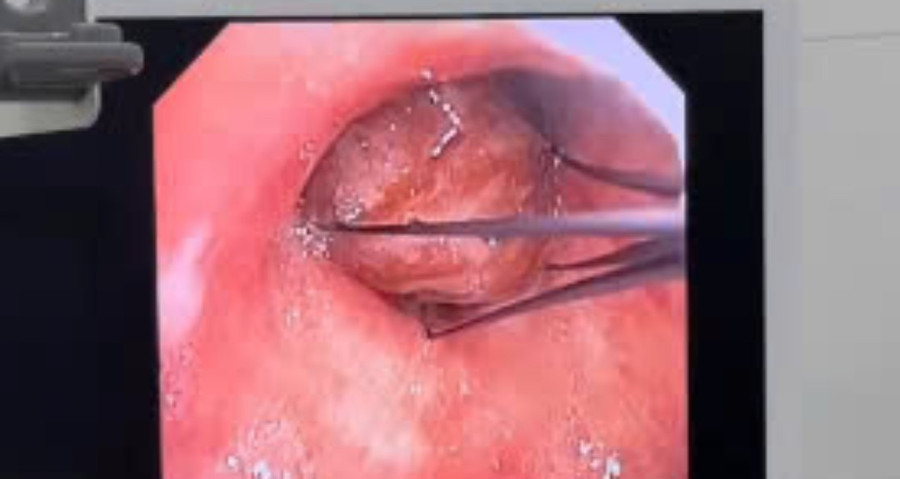 bác sĩ phát hiện dị vật nằm sâu trong phế quản gốc trái – vị trí có nguy cơ làm tắc nghẽn khí quản dẫn đến suy hô hấp cấp.