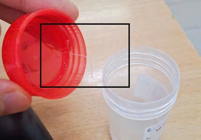 Mẫu bệnh phẩm ký sinh trùng dài 10 cm lấy ra khỏi mắt bệnh nhân.