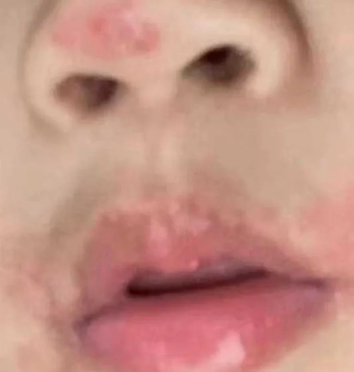 quanh vùng miệng: phồng rộp, sưng đỏ, ngứa rát kéo dài.