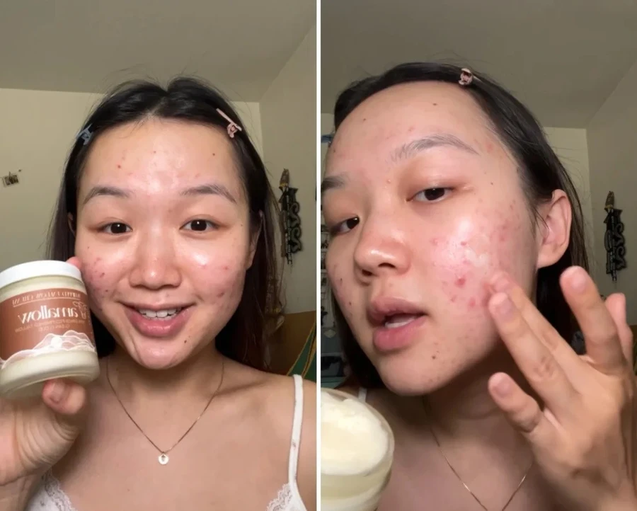 Trào Lưu Mới Nổi: 'Botox Từ Thiên Nhiên'