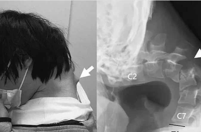 Cho thấy tác động nghiêm trọng của tư thế cúi đầu kéo dài đến hệ cơ xương cổ.