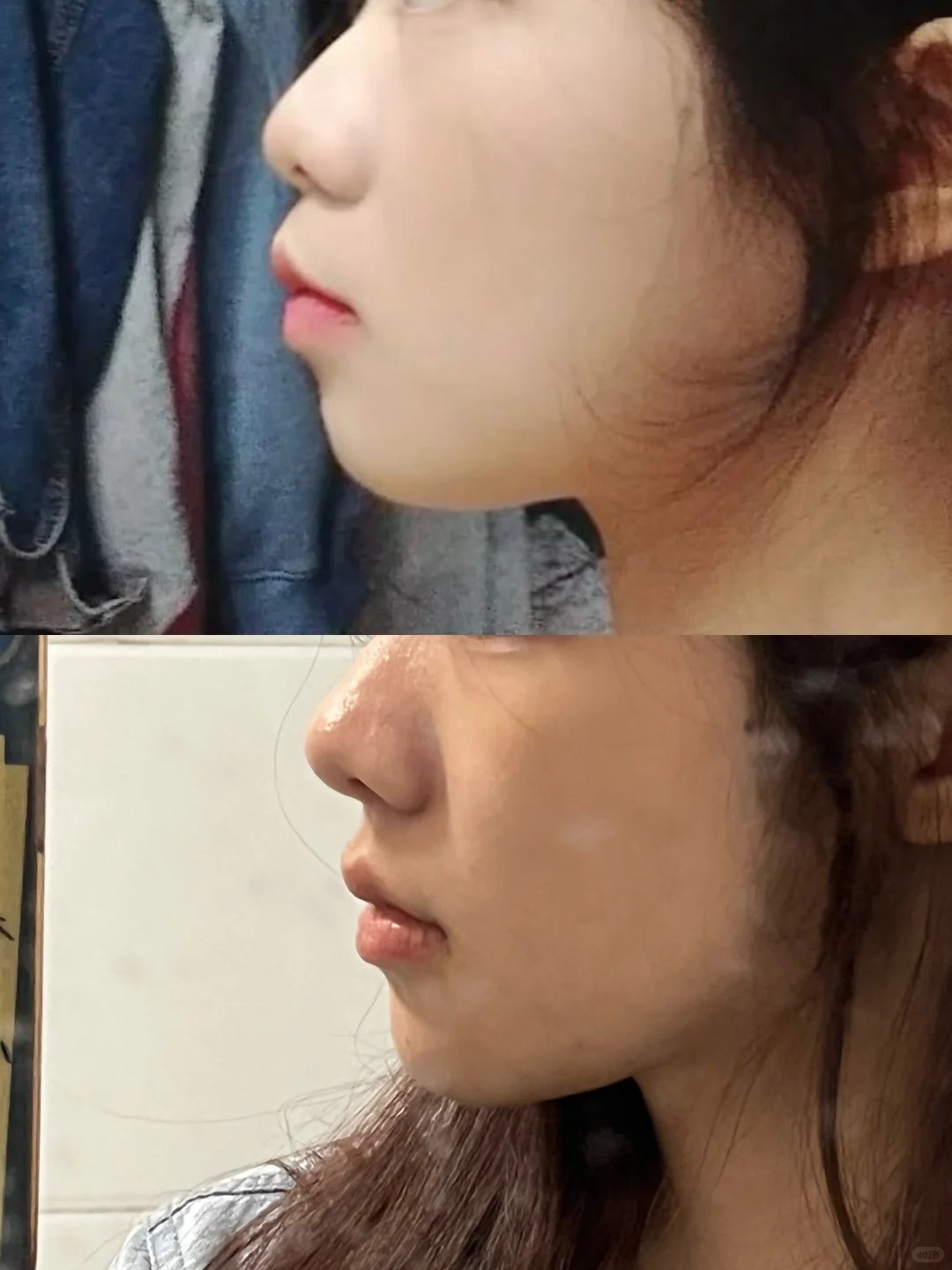 “Nâng cấp” góc nghiêng không cần dao kéo