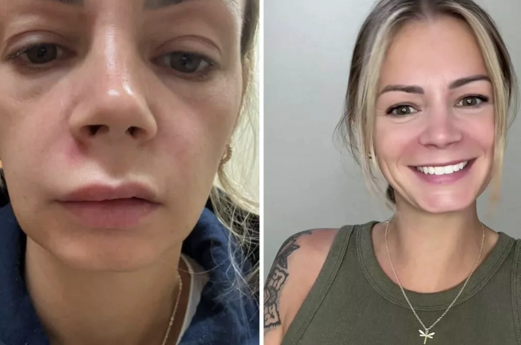 Một nốt mụn nhỏ tưởng chừng vô hại đã khiến một bà mẹ ba con tại Mỹ rơi vào tình cảnh nhập viện khẩn cấp.