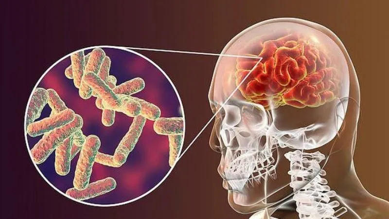 Bệnh não mô cầu diễn tiến nhanh, tỷ lệ tử vong cao và để lại di chứng nặng nề nếu không được điều trị kịp thời