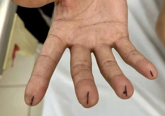 Kịch bản nguy kịch từ một cú chích máu