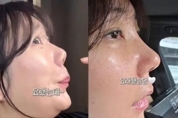 Nữ diễn viên hài Hàn Quốc phải chỉnh sửa mũi sau 21 năm phẫu thuật
