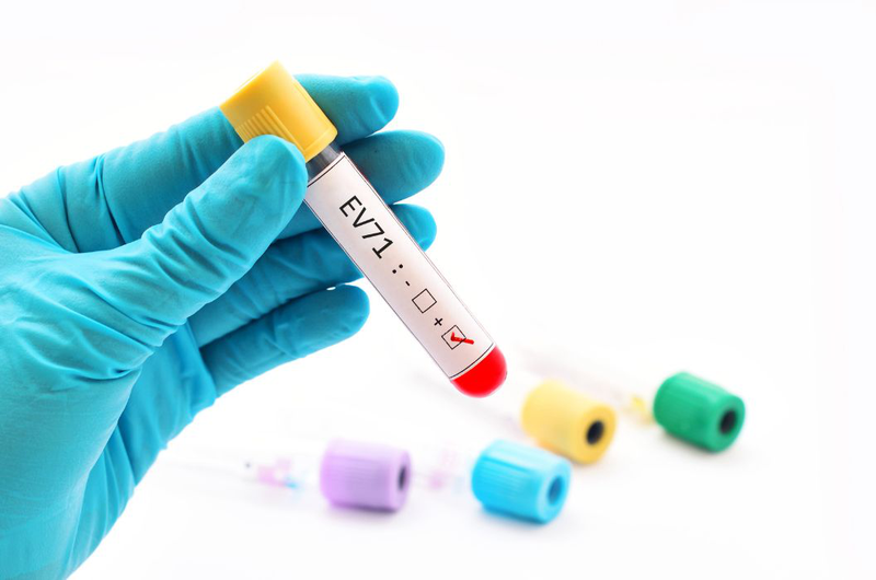 chủng EV71 đang trở thành nguyên nhân chính gây tay chân miệng nặng.