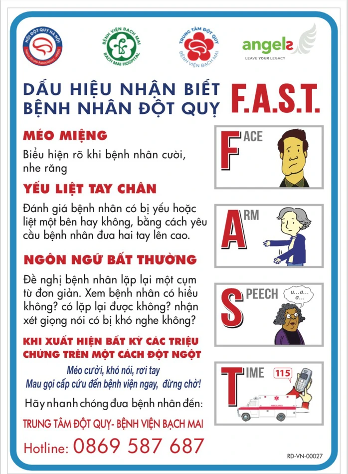 Những dấu hiệu cảnh báo đột quỵ cần được cấp cứu ngay. Ảnh: Bệnh viện Bạch Mai