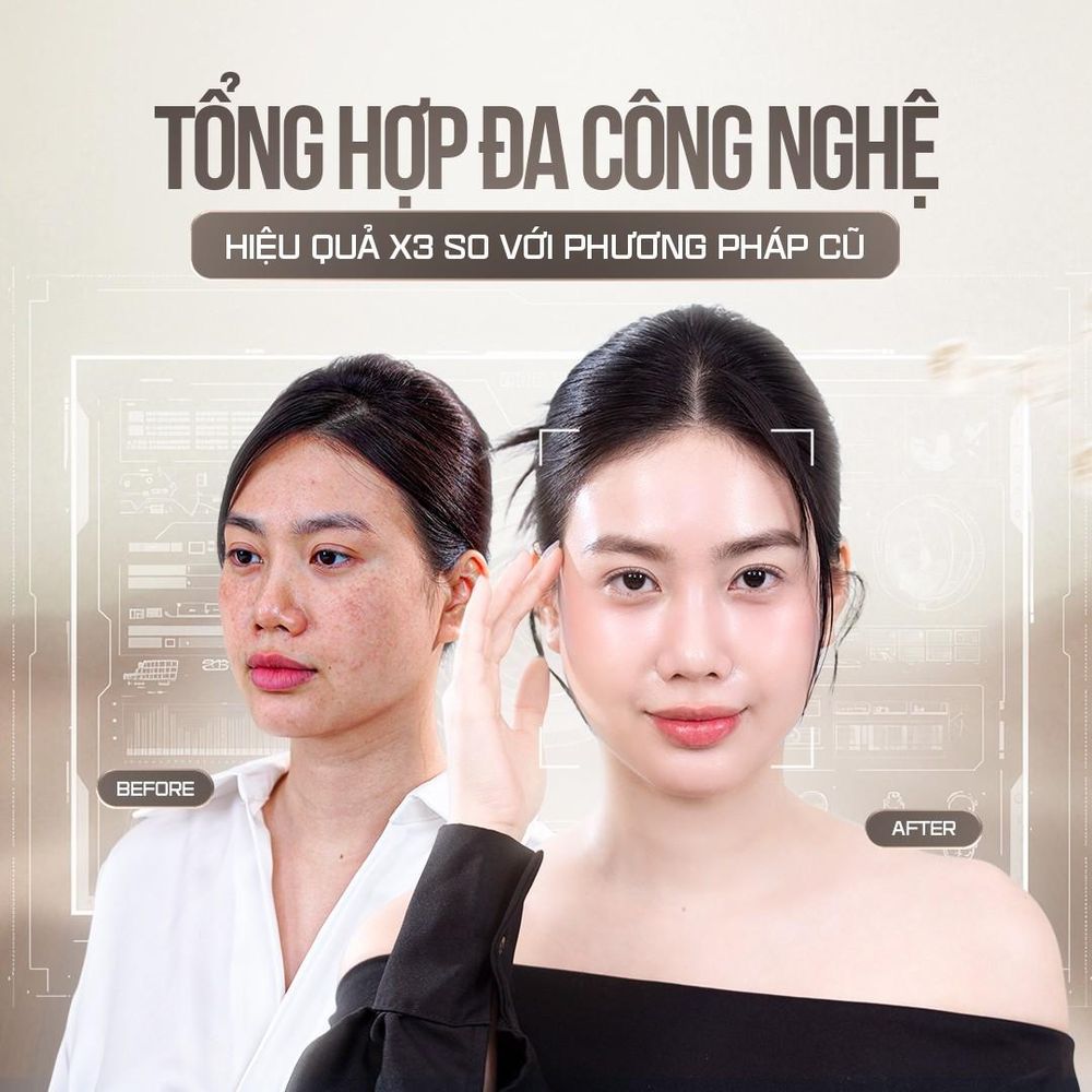 xử lý nám với độ chính xác cao, rút ngắn thời gian hồi phục và mang lại kết quả an toàn, hiệu quả cho từng người điều trị.